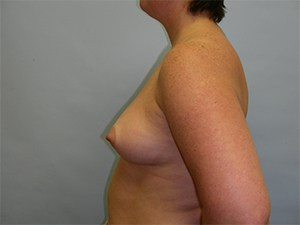 Breast Augmentation before and after - before