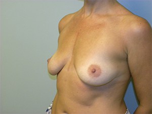 Breast Augmentation before and after - before
