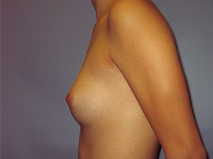 Breast Augmentation before and after - before