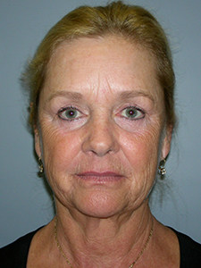 Facelift before and after - before