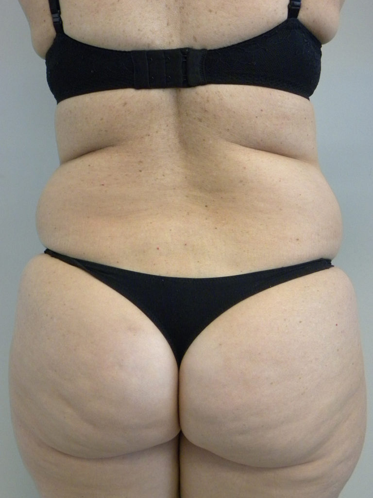Liposuction before and after - before