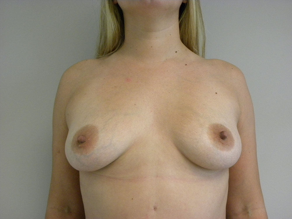 Breast Augmentation before and after - before