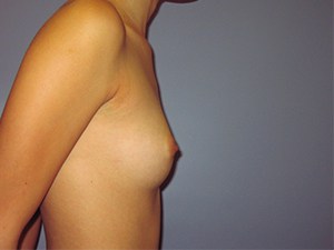 Breast Augmentation before and after - before