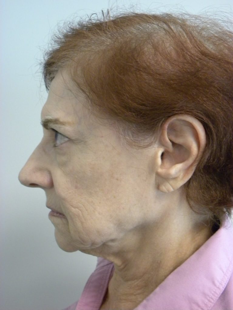 Facelift before and after - before