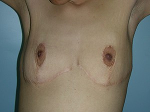 Breast Augmentation before and after - before