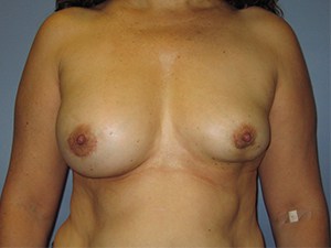 Breast Augmentation before and after - before