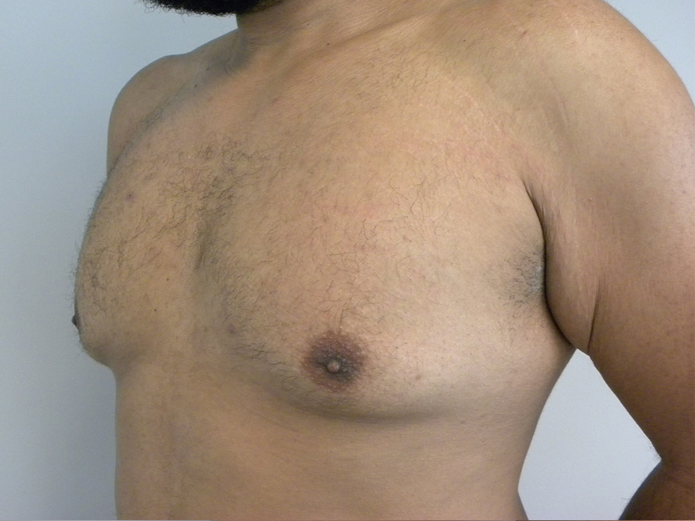 Liposuction before and after - before