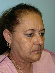 Facelift before and after - before