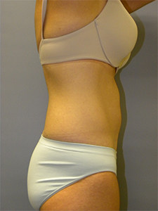 Liposuction before and after - before