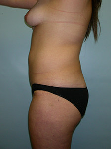 Liposuction before and after - before