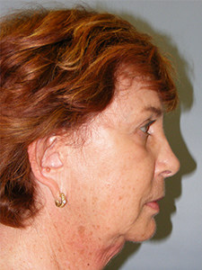 Facelift before and after - before