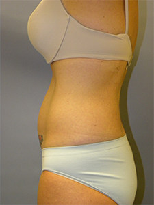 Liposuction before and after - before