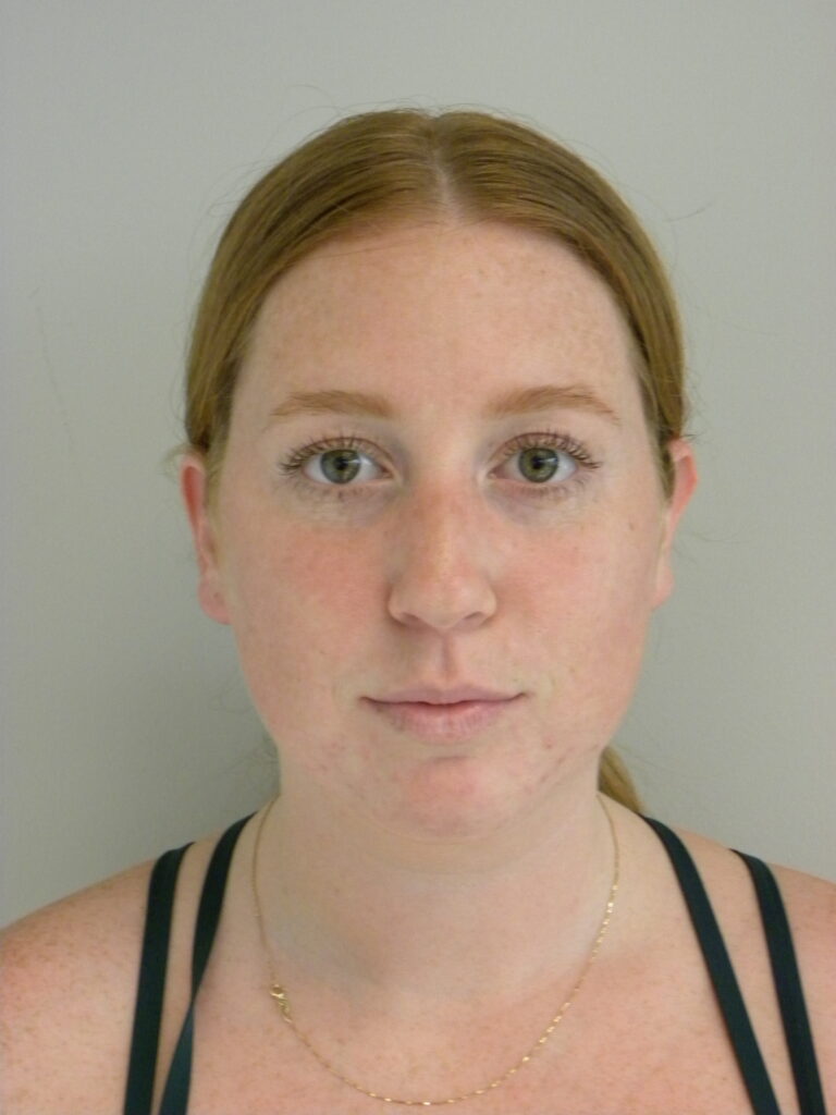 Chin before and after - before