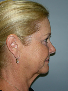 Facelift before and after - before