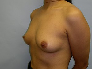 Breast Augmentation before and after - before