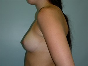 Breast Augmentation before and after - before
