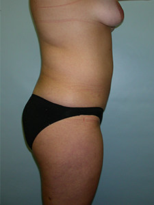 Liposuction before and after - before