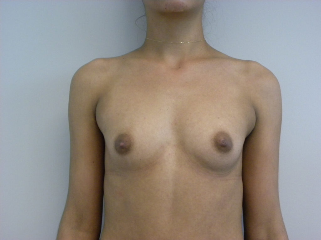 Breast Augmentation before and after - before