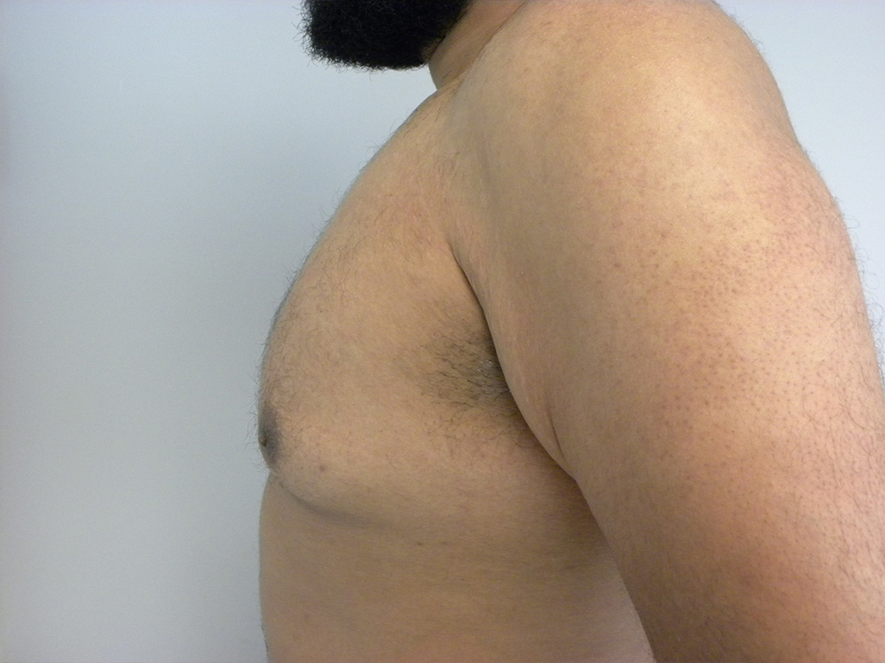 Liposuction before and after - before