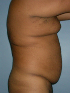 Liposuction before and after - before