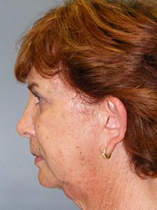 Facelift before and after - before