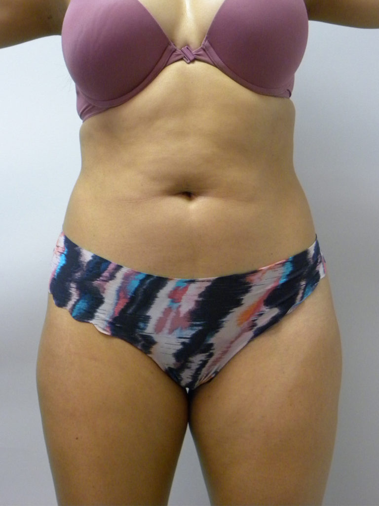 Liposuction before and after - before