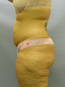 Liposuction before and after - before