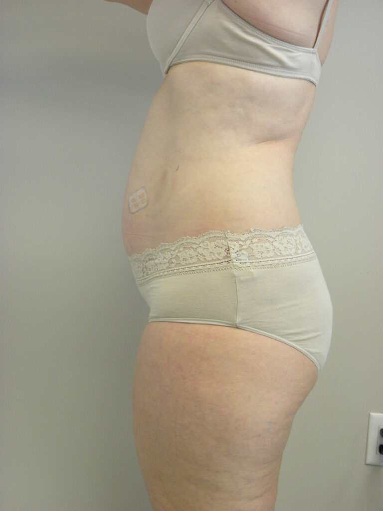 Liposuction before and after - before