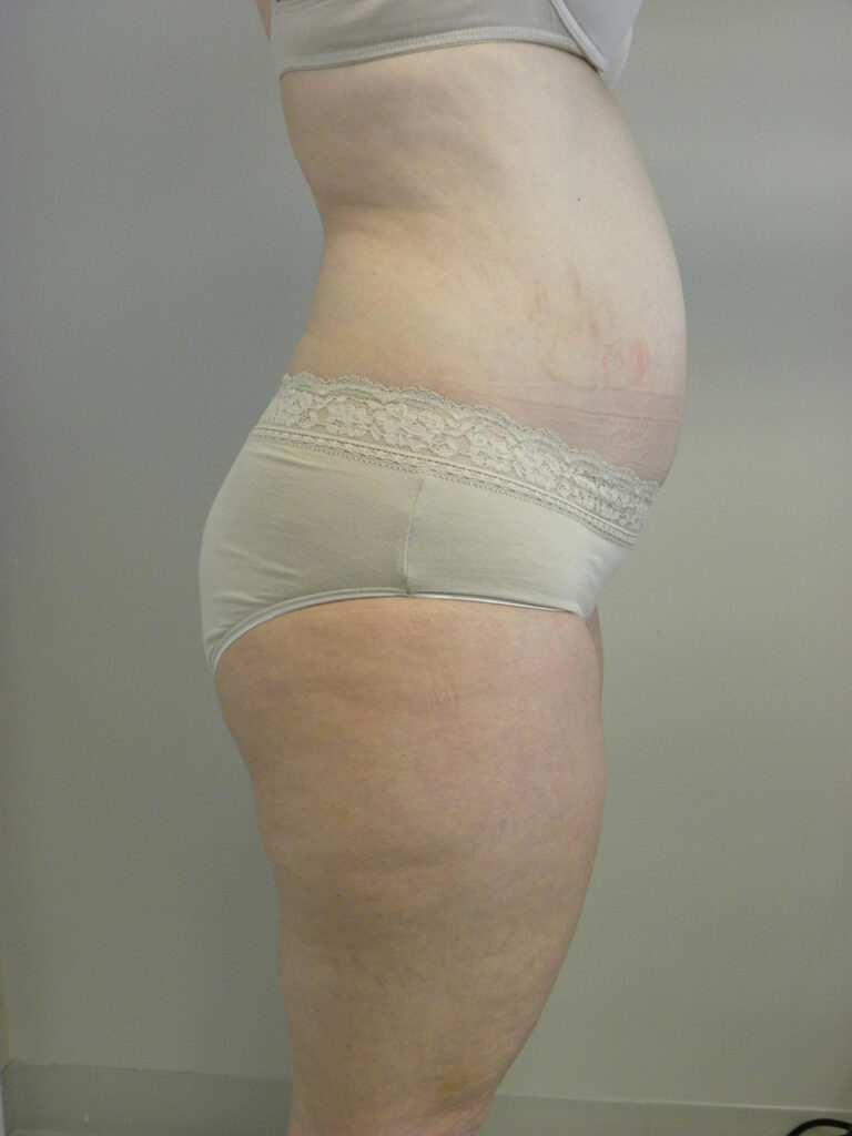 Liposuction before and after - before