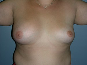 Breast Augmentation before and after - before