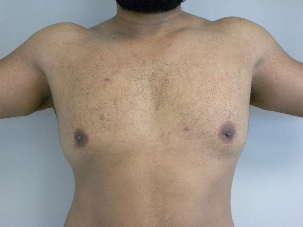 Liposuction before and after - before