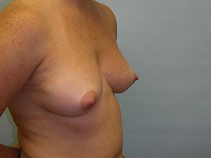 Breast Augmentation before and after - before