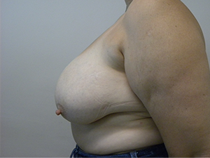 Breast Reduction before and after - before