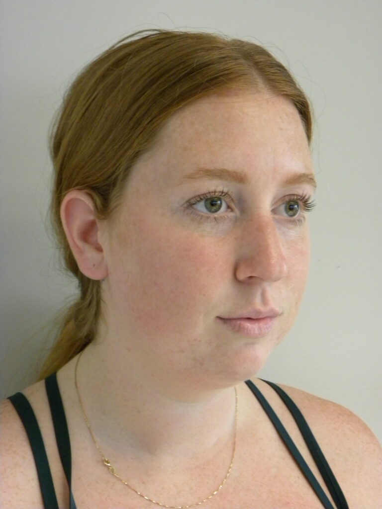 Chin before and after - before