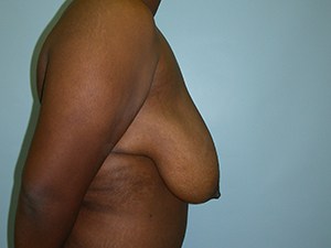 Breast Reduction before and after - before