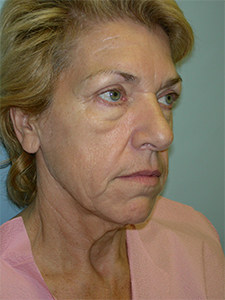 Facelift before and after - before