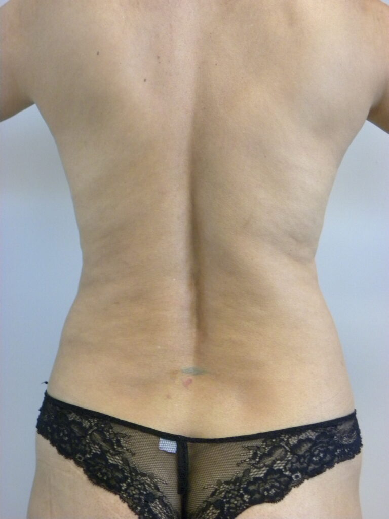 Liposuction before and after - before