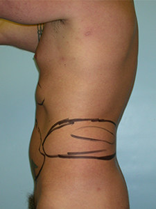 Liposuction before and after - before