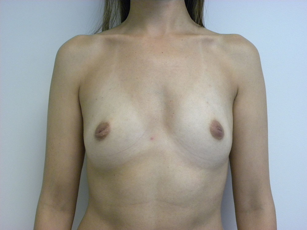 Breast Augmentation before and after - before