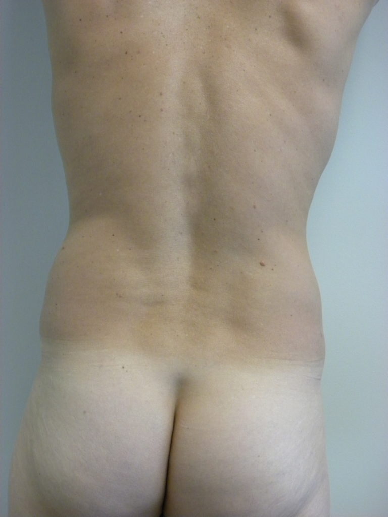 Liposuction before and after - before
