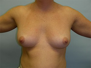 Breast Augmentation before and after - before
