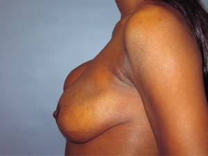 Breast Augmentation before and after - before