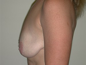 Breast Lift before and after - before