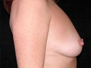 Breast Augmentation before and after - before