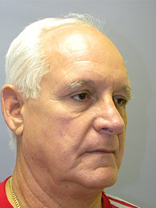 Facelift before and after - before
