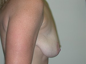 Breast Lift before and after - before
