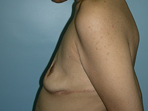 Breast Augmentation before and after - before