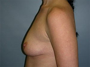 Breast Augmentation before and after - before