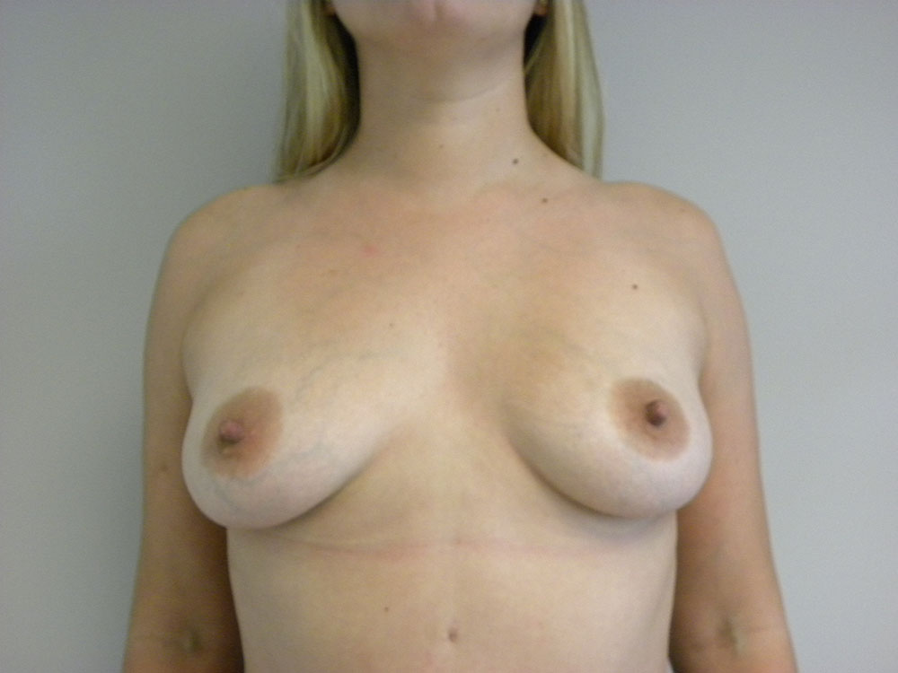 Breast Augmentation before and after - before