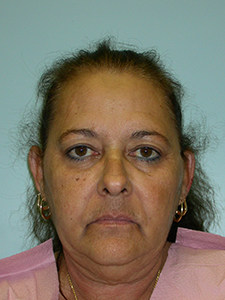 Facelift before and after - before